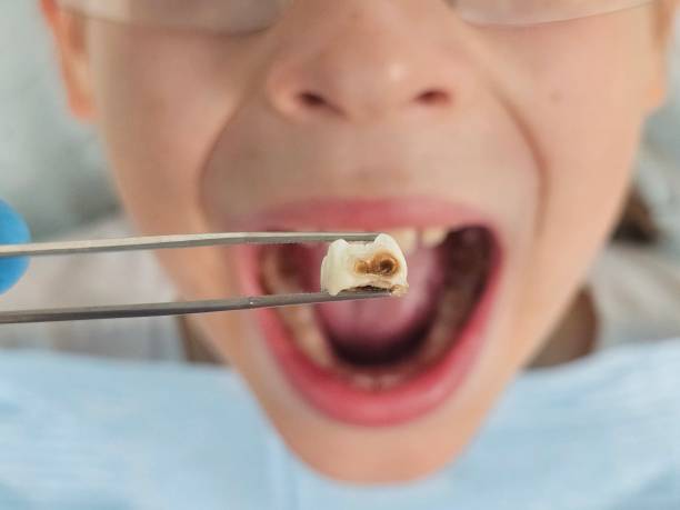 Best Emergency Wisdom Tooth Extraction in East Speer, NC